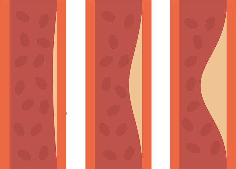 Plan-Accion-Colesterol-Hipercolesterolemia_Simple-Blending